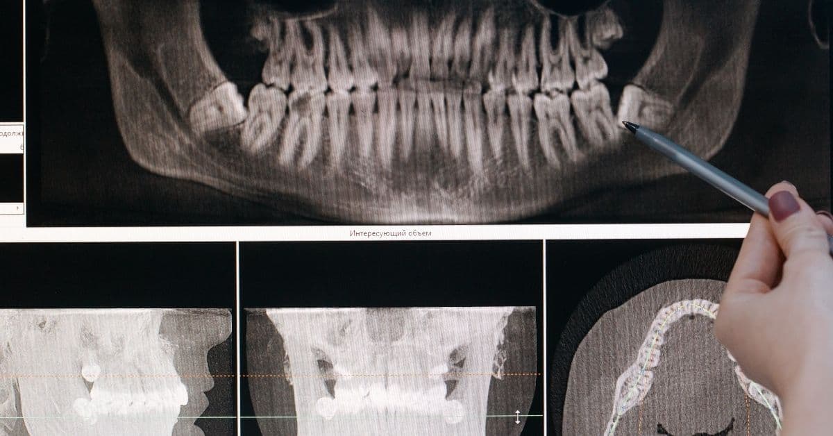 Wisdom teeth extraction