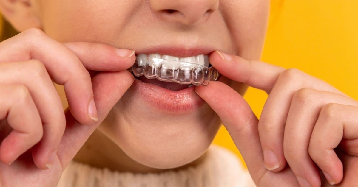 Transparent orthodontics