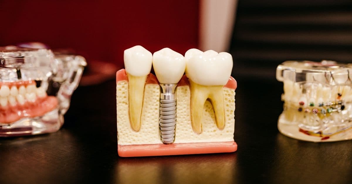 Dental implants