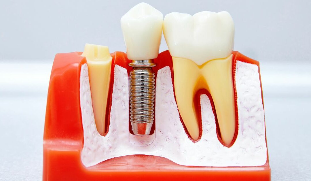 Why is cigarette smoke the No. 1 enemy of dental implants?