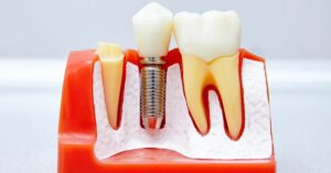 Why is cigarette smoke the No. 1 enemy of dental implants?