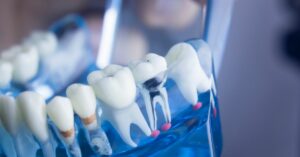 Qual è la differenza fra placca e tartaro?