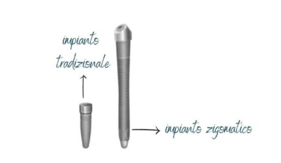 What are zygomatic implants?