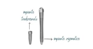 Cosa sono gli impianti zigomatici?