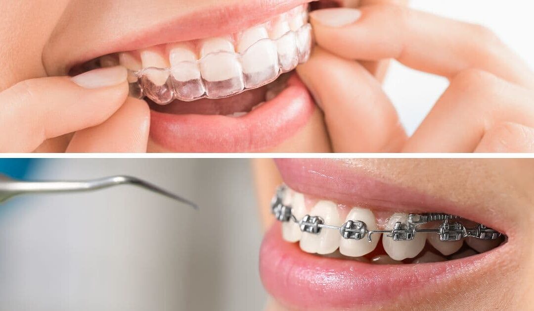 Quali sono i vantaggi di Invisalign® rispetto all’ortodonzia tradizionale (apparecchio fisso)?