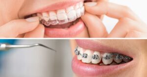 Quali sono i vantaggi di Invisalign® rispetto all’ortodonzia tradizionale (apparecchio fisso)?