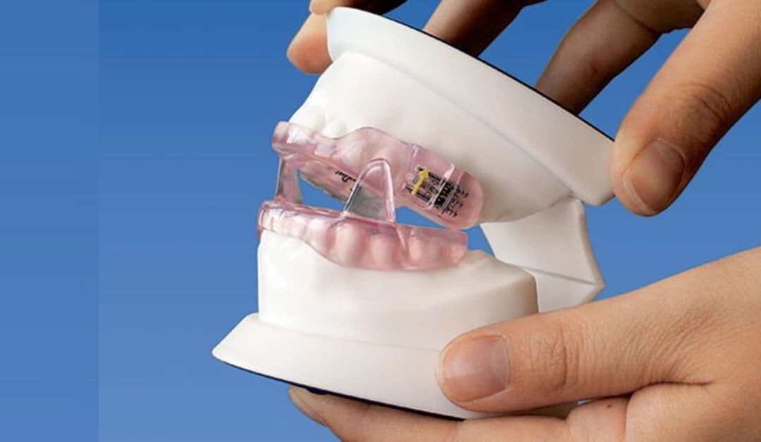 Apnee ostruttive del sonno e il ruolo del dentista nella diagnosi e trattamento