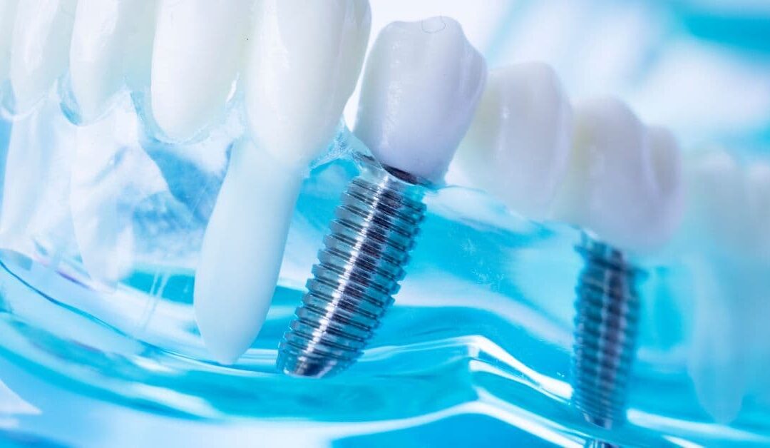 Hai appena messo un impianto dentale? Ecco 6 consigli da seguire