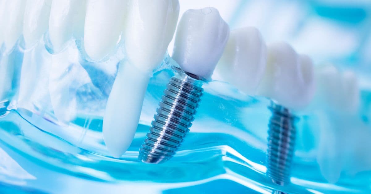 impianti-dentali-post-operatorio