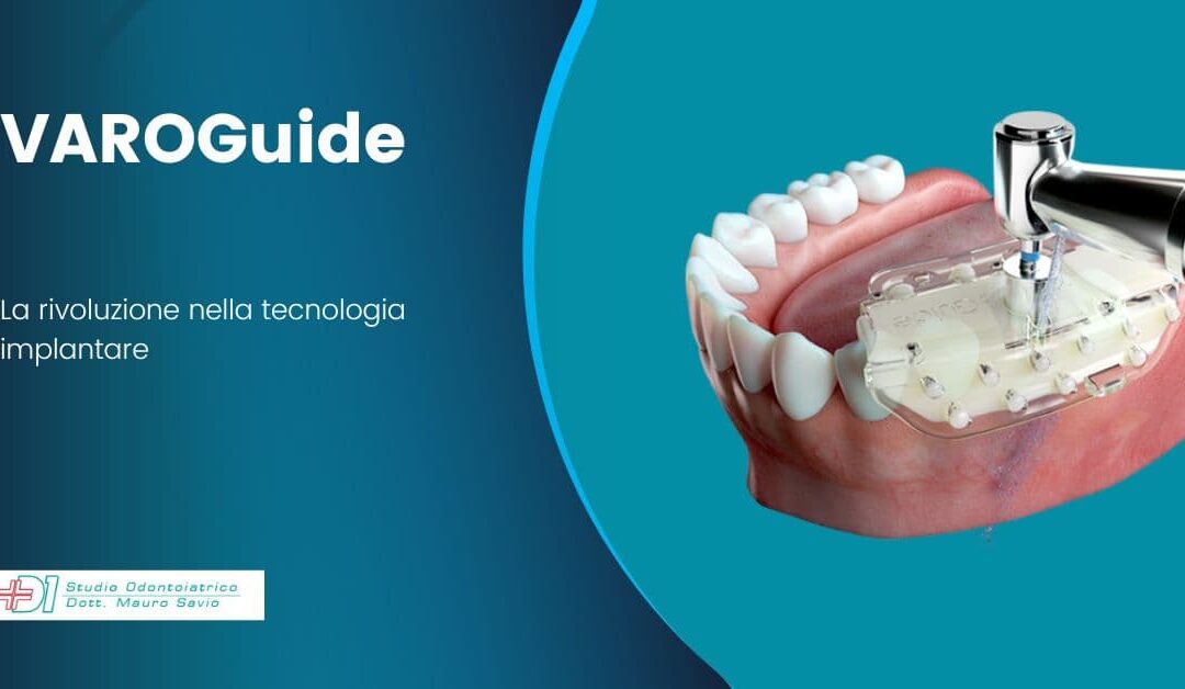 Dental1 Introduces VAROGuide: the revolution in implant surgery