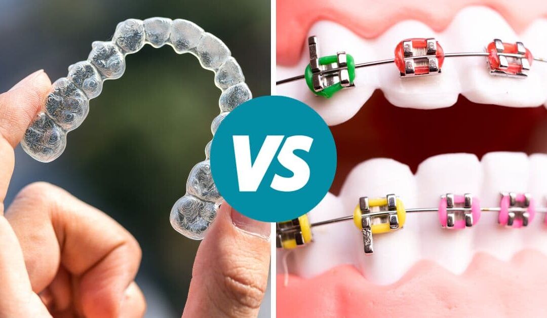 Invisalign® vs apparecchio fisso: una tabella comparativa