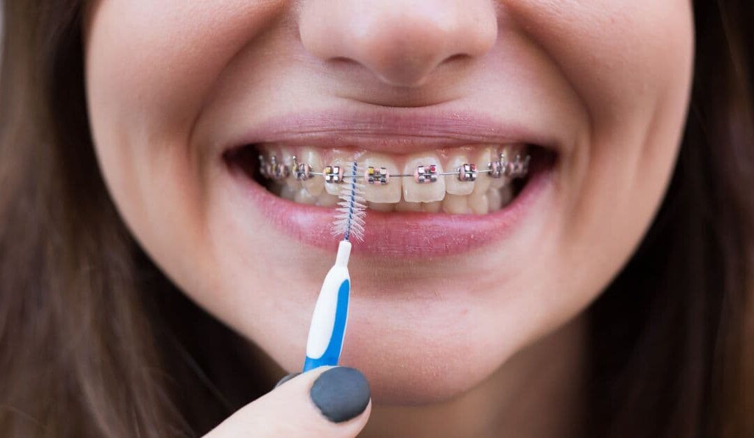 Oral hygiene with fixed braces: how to brush your teeth with brackets