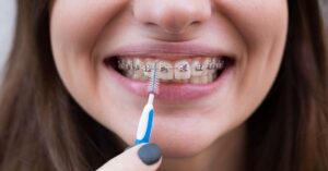 Oral hygiene with fixed braces: how to brush your teeth with brackets