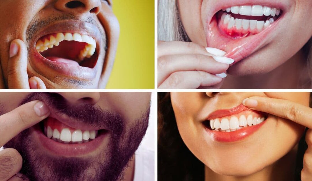 Почему десны меняют цвет?