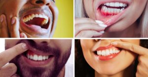 Why do the gums change color?