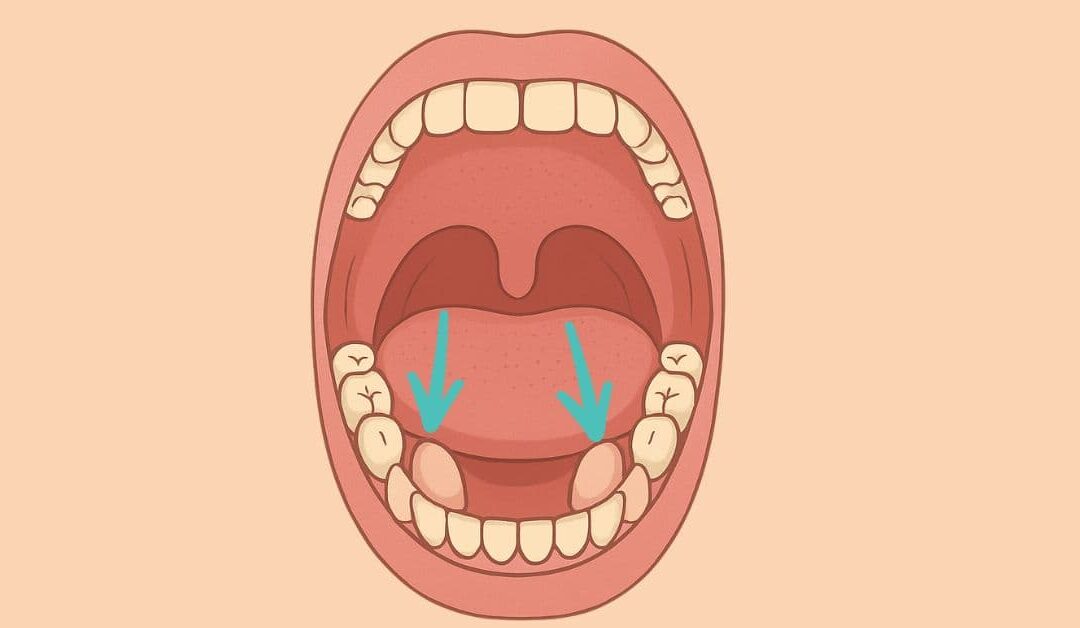 Torus mandibularis: что это такое, почему он появляется, когда и как его удалить