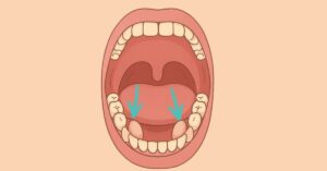 Torus mandibularis: what it is, why it appears, when and how to remove it